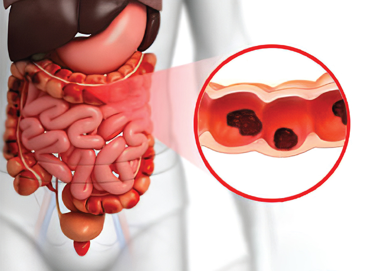 ABDOMINAL TUBERCULOSIS DIAGNOSIS AND TREATMENT