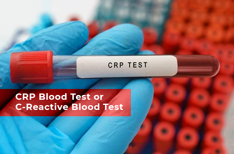 Learn About CRP Blood Test Or C Reactive Protein Blood Test